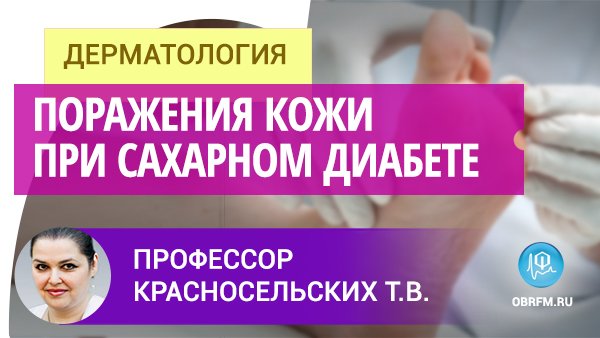 Профессор Красносельских Т.В.: Поражения кожи при сахарном диабете смотреть онлайн