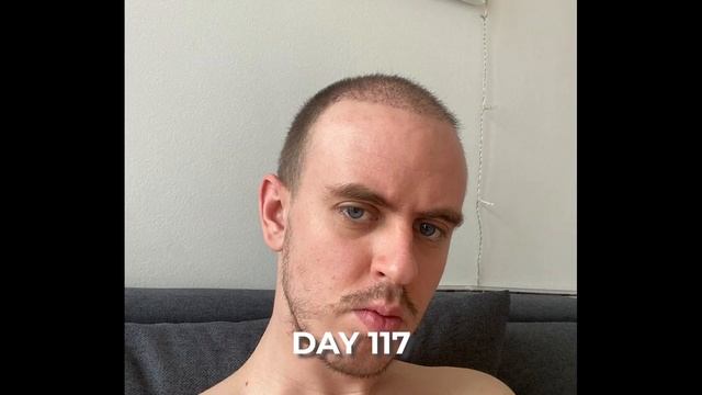 Hair Transplant 1 Year Progress