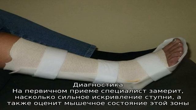 Что такое конская стопа смотреть онлайн