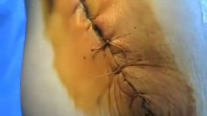 Снятие швов