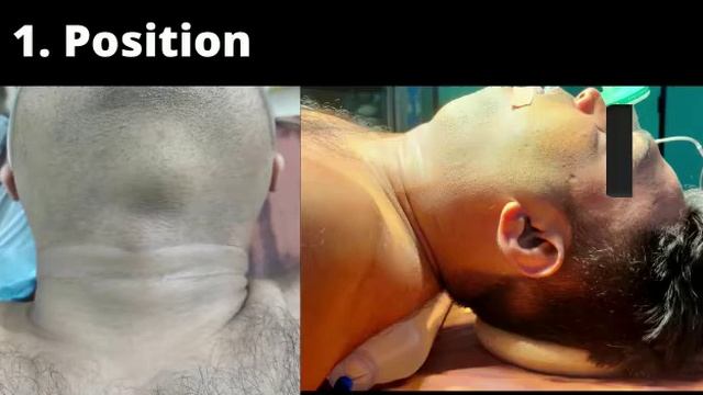 Submental lymph node/Gland Excision смотреть онлайн