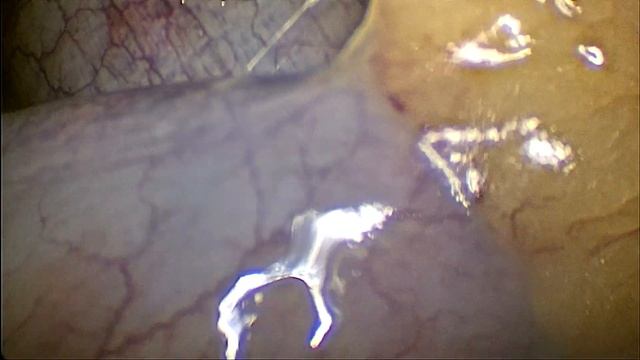 Острый мезентериальный тромбоз