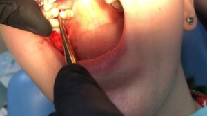 Удаление сверхкомплектного зуба