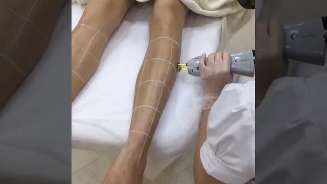 Лазер CANDELA GentleLASE Pro. Эпиляция области голени (секторы). смотреть онлайн