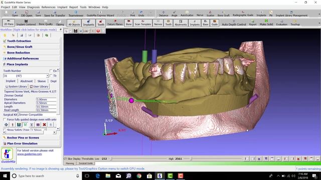 GuideMia Planning with Exocad смотреть онлайн