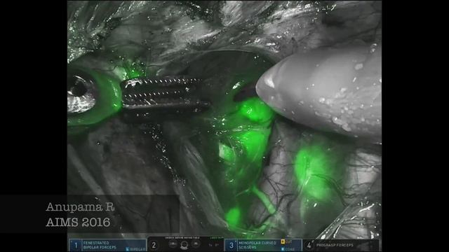 Sentinel Node Mapping - Endometrial cancer- Robotic Platform смотреть онлайн