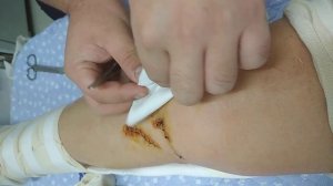 Снимают дренаж, вытаскивают трубку из раны оперированного колена, 29.01.23. Ору ?❤️. Корея, Больниц