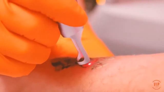 PicoLazer - Tattoo Removal смотреть онлайн