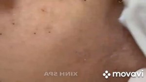 ОЧЕНЬ КРАСИВО Выдавливание Черных точек   Самое залипательное видео   выдавливание прыщей, ??