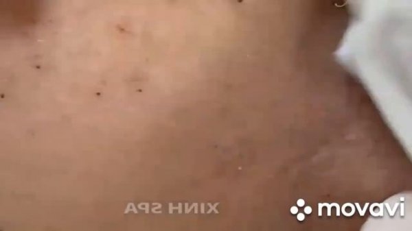ОЧЕНЬ КРАСИВО Выдавливание Черных точек   Самое залипательное видео   выдавливание прыщей, ??