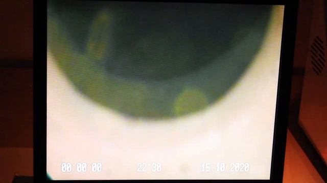 ПСА Цистоскопия смотреть онлайн