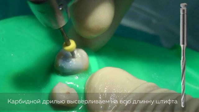 Извлечение стекловолоконного штифта с помощью карбидной дрили смотреть онлайн