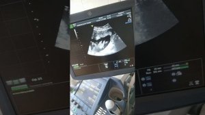 УЗИ двойня. 20-21 неделя