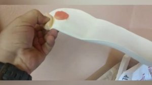 Индивидуальные стельки при ампутации первого пальца