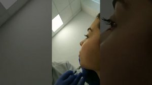 Увеличение подбородка филлерами Стилейдж. Подробно всё рассказываю и показываю.