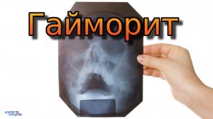 Можно ли лечить гайморит самостоятельно?