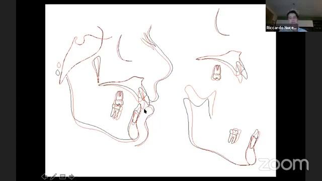 Class II treatment correction || Prof.Riccardo Nucera смотреть онлайн