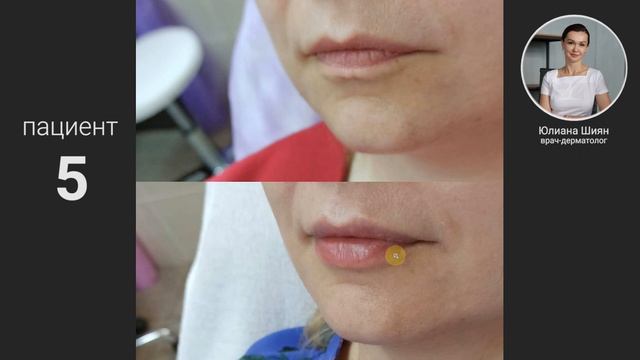 Губы До и После - коррекция поджатой нижней губы смотреть онлайн