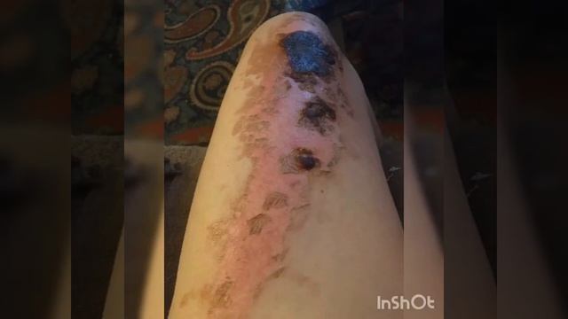 Как заживает ожог смотреть онлайн