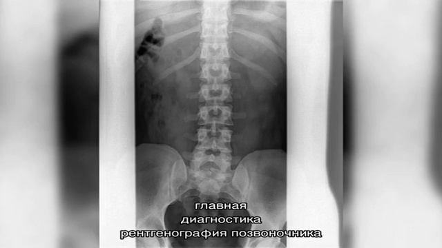 Рентген I-II шейных позвонков в Москве смотреть онлайн