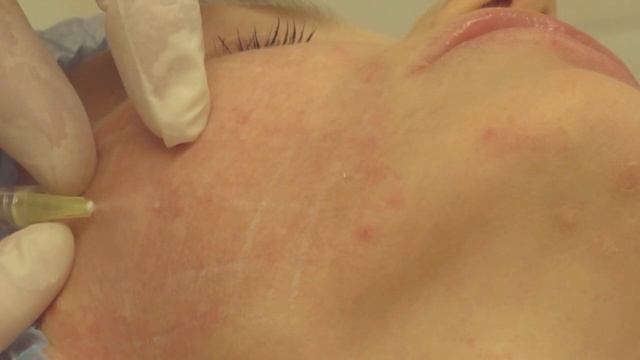 Проведение процедуры векторного лифтинга. смотреть онлайн