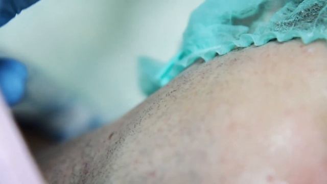 Ультразвуковая чистка лица смотреть онлайн