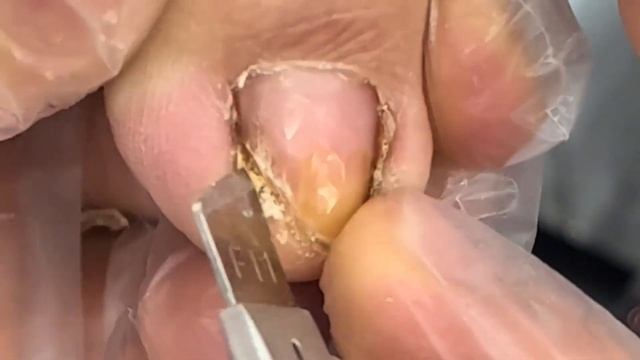The complete ingrown toenail trimming process! смотреть онлайн