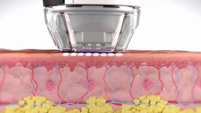 Фракционное омоложение Matrix RF