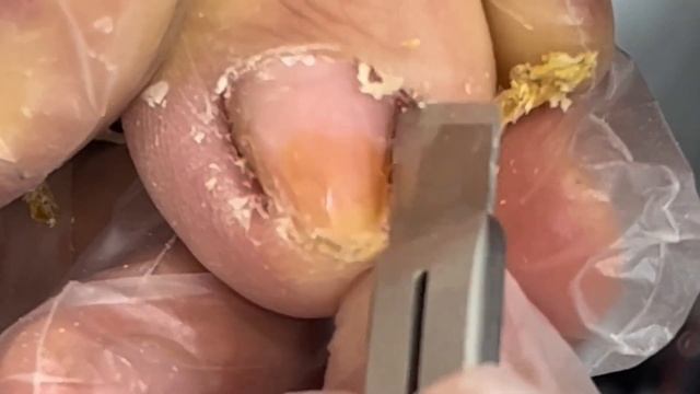 Pedicure Tutorial: The Complete Ingrown Toenail Repair Process!