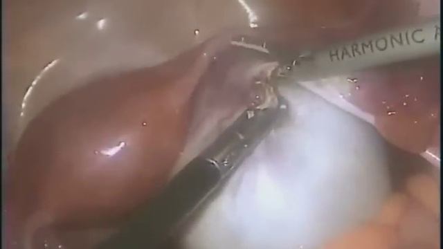 Large Ovarian Cyst (10cm) - Laparoscopic Ovariotomy смотреть онлайн
