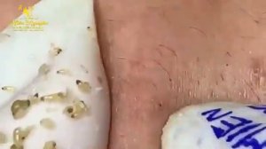 ? Выдавливание прыщей | Удаление и выдавливание прыщей и черных точек 2021 | Прыщи выдавливание #01