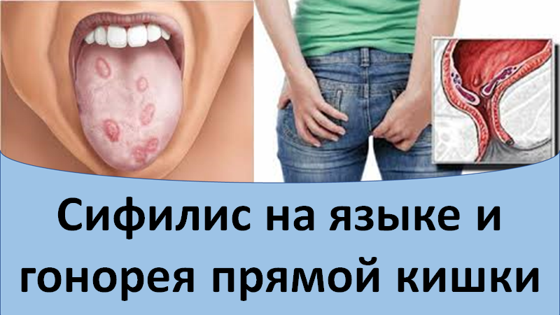 Сифилис на языке и гонорея прямой кишки смотреть онлайн