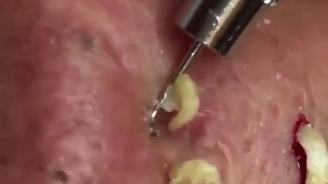 выдавливание прыщей, чистка лица, пилинг смотреть онлайн