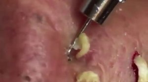 выдавливание прыщей, чистка лица, пилинг