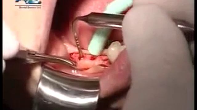 Импланты АВ израиль