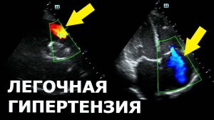 Как вычислить легочную гипертензию?