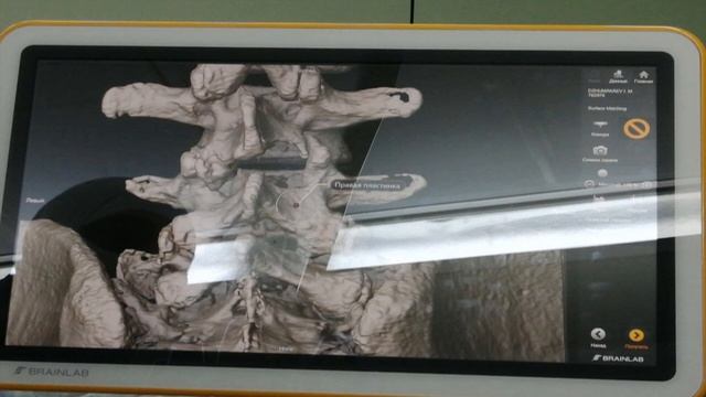 Сургутские нейрохирурги теперь пользуются современной нейронавигацией во время операций смотреть онлайн
