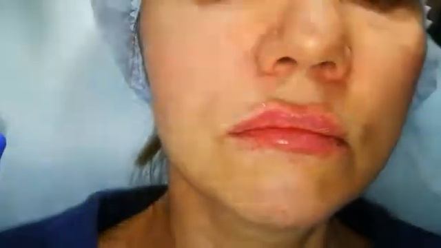 18.07.2017 Алматы, Ольга Глебовна. Моделирование губ. Видео 7 смотреть онлайн