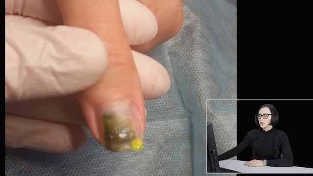 Рубрика "Тяжелый случай": онихолизис (отслойка ногтя) + синегнойная палочка смотреть онлайн