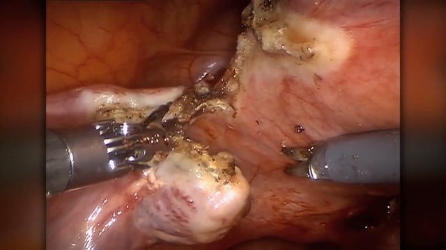 Watch a robotic hysterectomy at UnityPoint Health - St. Luke's Hospital смотреть онлайн