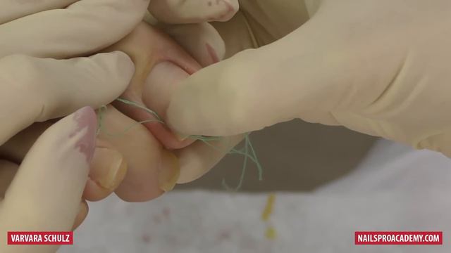 How To Fix Ingrown Toenails Easily