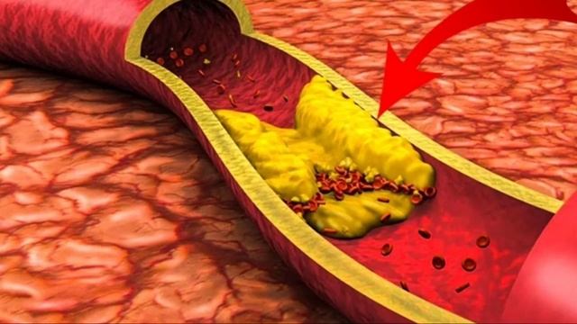 Камни в желчном пузыре. смотреть онлайн