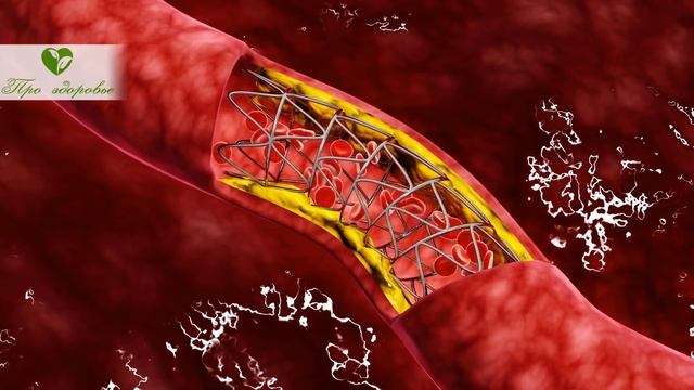 Ураганный результат! Простой яблочный уксус помогает мне предотвращать тромбы, укрепить сосуды... смотреть онлайн
