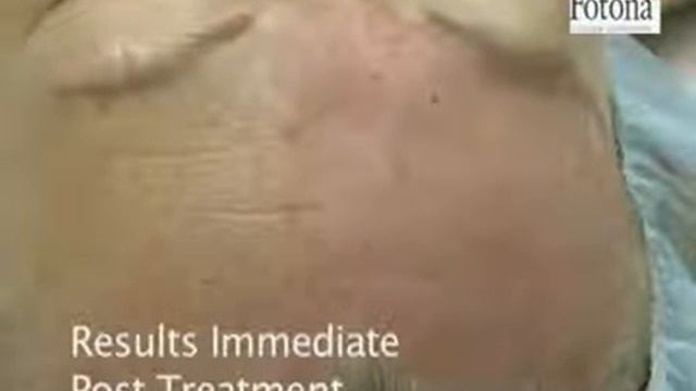 Горячий лазерный пилинг лазером Fotona смотреть онлайн