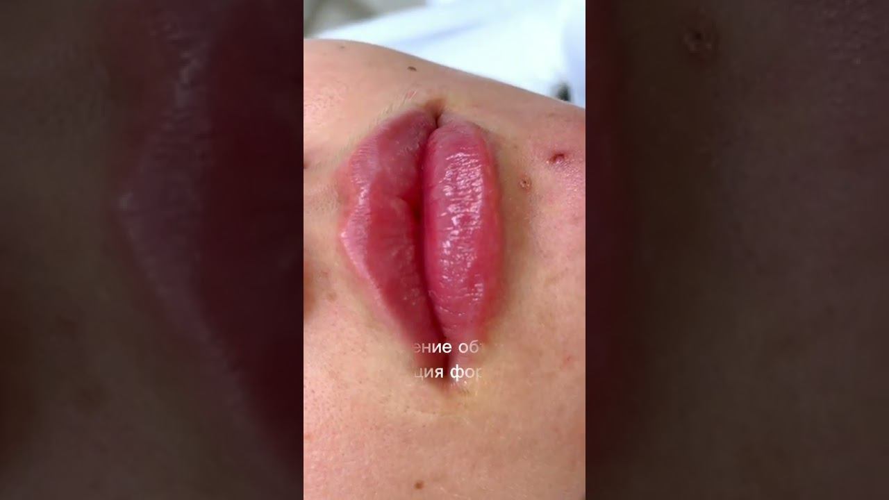 #губы сразу после контурной пластики смотреть онлайн