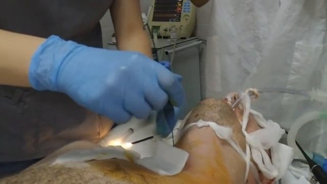 Пункционно-дилятационная трахеостомия.