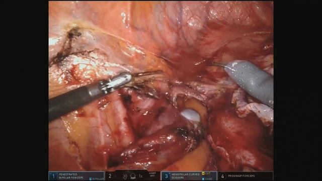 Atypical Locations of Sentinel Lymph Nodes in Endometrial Cancer смотреть онлайн
