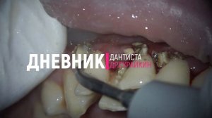 удаление зубного камня и зубного налета ультразвуком #стоматология #пломба #имплант #кариес #