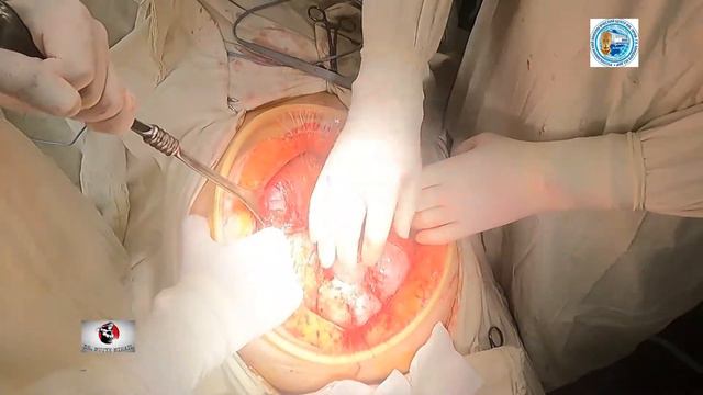 Ovarian Cancer Cytoreductive Surgery/Рак Яичников, Максимальная Циторедукция смотреть онлайн