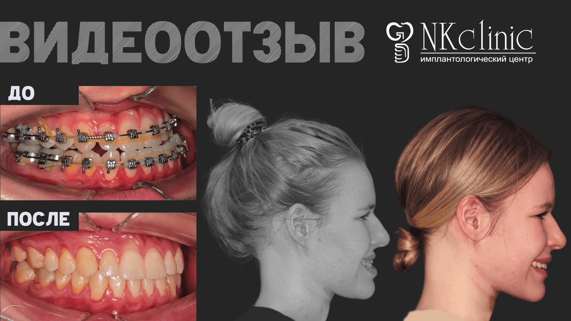 NKclinic - отзывы пациентов. Честно об исправлении асимметрии лица и неправильного прикуса.